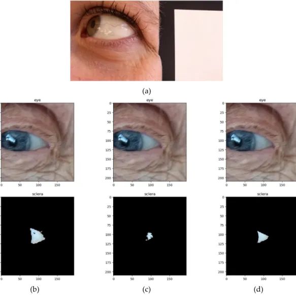 Figure 1. Examples of eye pictures taken during the study. (a) Native image of a 37-year-old woman  without ID and no blue sclera with the white patch of the color checker