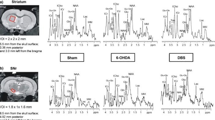 Fig. 3 In vivo proton magnetic resonance spectroscopy acquisitions.