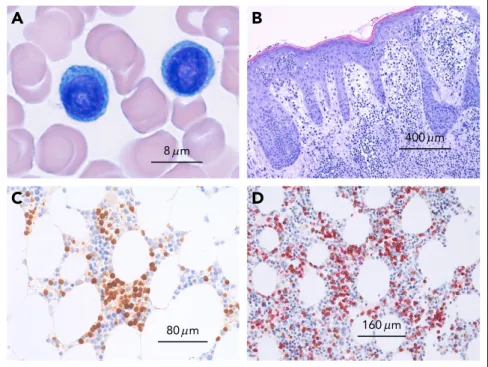 Figure 1. Microscopy of T-cell prolymphocytic leu- leu-kemia. (A) Peripheral blood smear showing 2  medium-sized atypical lymphocytes with round nuclei and prominent nucleoli and abundant basophilic cytoplasms without granules