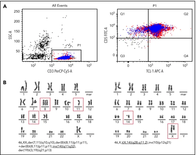 Figure 2. Immunophenotypic markers of T-PLL and typical chromosome banding analysis. (A) Flow cytometry of CD3 1 , CD5 1 , cytoplasmic TCL1 1 T-PLL cells