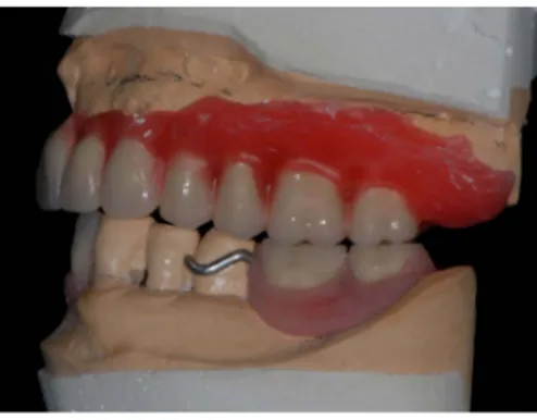 Figure 1. Articulator allowing the determination of  the prosthetic volume in which the implants must fit
