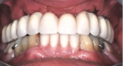 Figure 5. The finished prosthesis set in the mouth on the day of  installation.