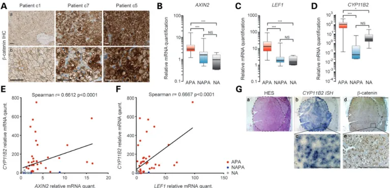 Figure 1. WNT/b-catenin pathway is activated in Conn’s syndrome patients. (A) Nucleo-cytoplasmic accumulation of b-catenin in APA