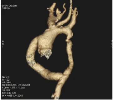 Fig. 1. Three-dimensional computed tomographic image (18-month post- post-operatively) showing isthmic aortic coarctation and ascending-to-descending aortic bypass performed using an 18 mm Dacron graft