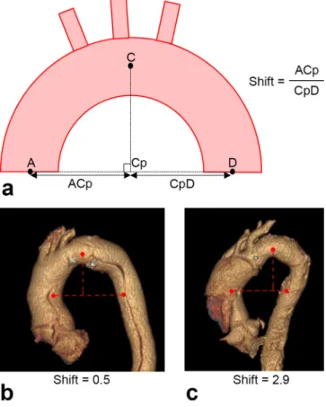 Figure 3. Example of a −30° (−1 h) rotation of the false lumen  between brachiocephalic artery trunk and left common  carotid artery.