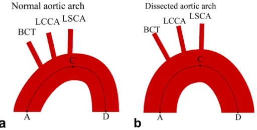 Figure 4. Schematic comparison of the morphology of normal and dissected aortic arches