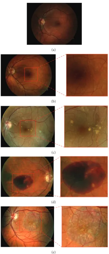 Figure 1: Images of macula area for diferent AMD categories: (a) healthy case in category {1} , (b) category {2} with hard drusen, (c) category {3} with sot drusen, and (d) category {4} with hemorrhages and (e) with geographic atrophy.