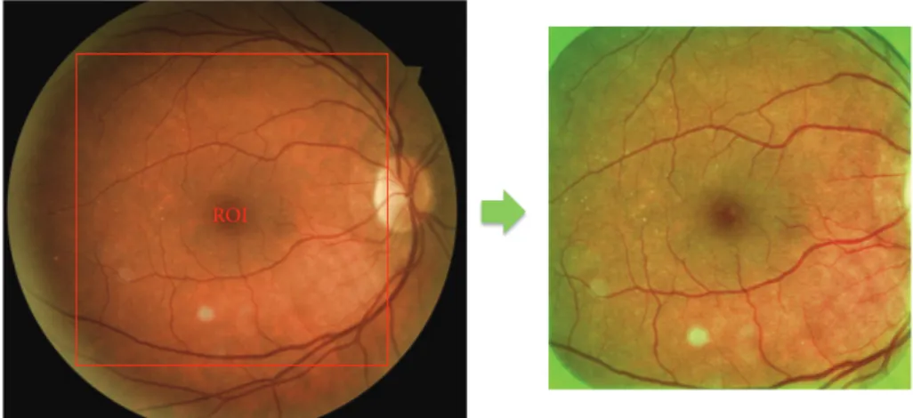 Figure 2: Preprocessing method: ROI corresponding to the square inscribed in the circle formed by the retina and the result of preprocessing with illumination normalization and contrast enhancement in green channel.