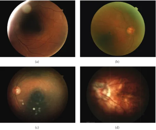 Figure 3: Examples of poor quality images: (a) shadows and intense relections, (b) haze, (c) arc and specular relections, and (d) blur.