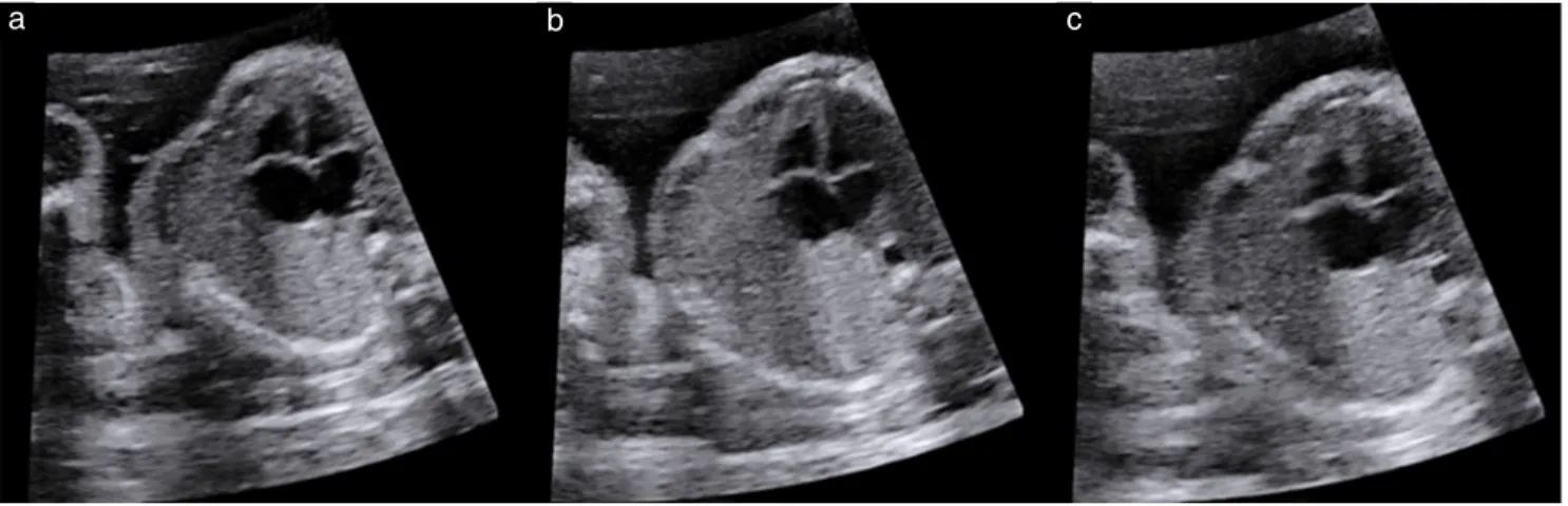 Figure 1 Set of three images of four-chamber view of fetal heart obtained at ultrasound propagation velocity settings of 1420 m/s (a), 1480 m/s (b) and 1540 m/s (c) in an obese woman during mid-trimester examination