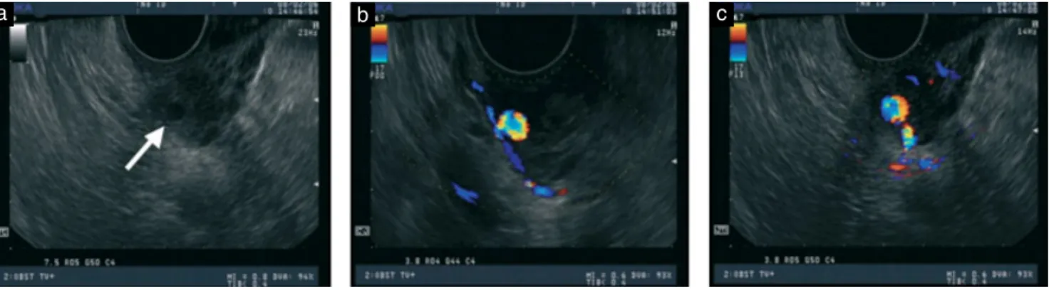 Figure 1 Ultrasonographic findings on admission: gray-scale ultrasound image showing a cystic lesion (arrow) in the lower left wall of the uterus (a) and color Doppler ultrasound images showing turbulent arterial flow within the cystic lesion in the longit