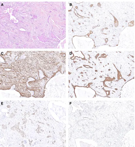Figure 3. Immunophenotypic profile of low-grade adenosquamous carcinomas of the breast (LGASCs)