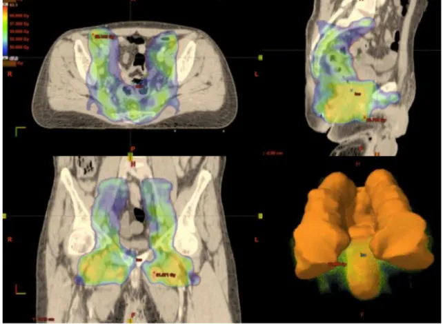 Fig. 1    Coverage of the prophylactic planning target volume by the 95% isodose (47 Gy) with intensity-modulated radiation therapy for locally  advanced anal canal carcinoma (T2N3, bilateral nodes)