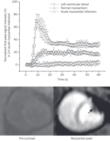 Figure 1.  Time intensity curves and representative images of first- first-pass perfusion MRI in acute myocardial infarction