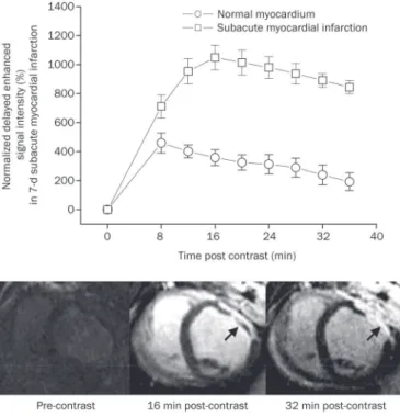Figure 5.  Time intensity curves and representative images of delayed  enhancement MRI in subacute myocardial infarction