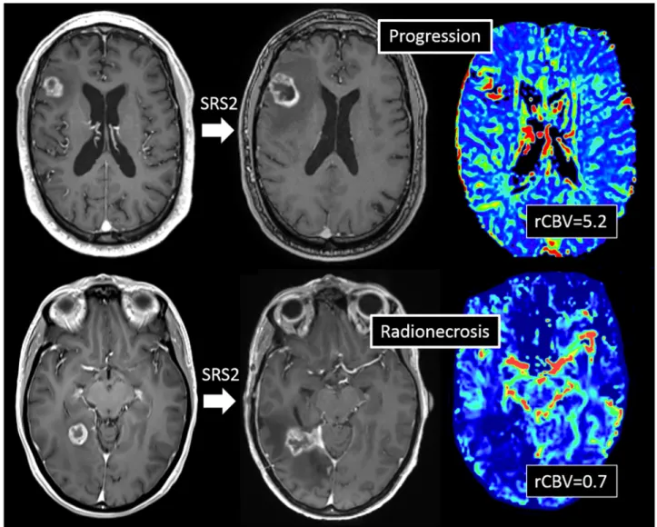 Fig 2. Example of brain metastasis treated with a second of radiosurgery (SRS2). Both metastasis showed an increase &gt; 20% in the longest diameter at 9 months, one with a high cerebral blood volume ratio (rCBV = 5.2) in favor of local progression (A) and