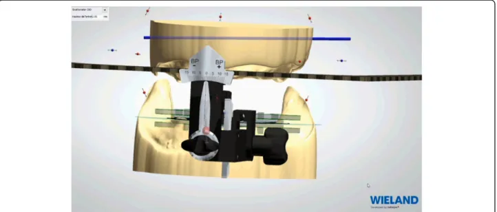 Fig. 8 Values of the UTS CAD® device are used to create primary digital model positioned on a virtual articulator