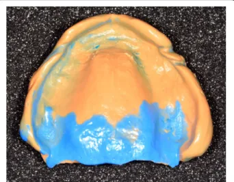 Fig. 14 Mandibular conventional functional impression with the manufactured tray