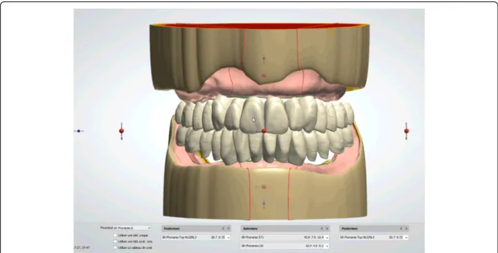 Fig. 23 A teeth setting is proposed by the 3shape software with posterior teeth positioned in an ideally bilateral balanced occlusion concept