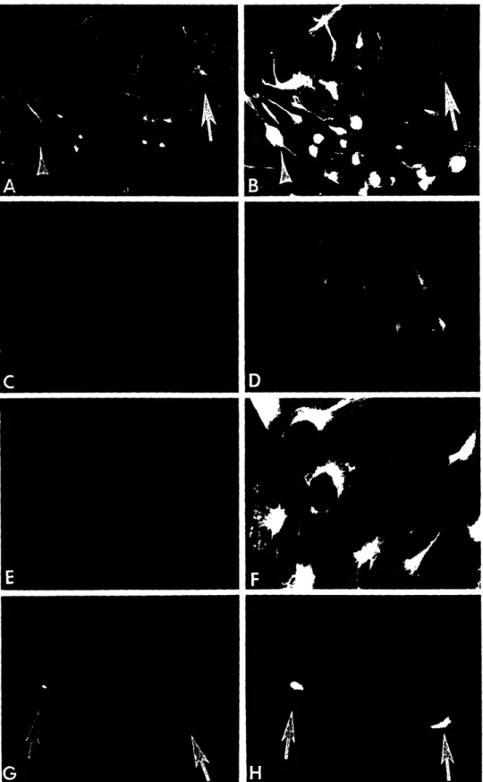 FIG.  5.  Double  immunofluorescence studies  of brain  tumor-derived  cell  lines are  shown  here