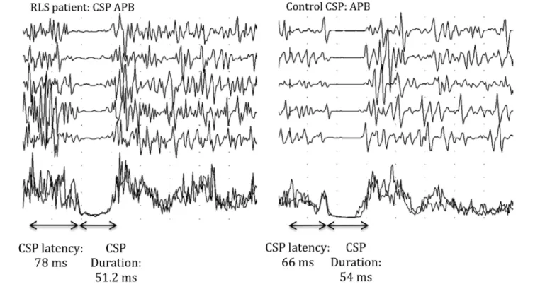 Table 2  illustrates  CSP  and  F-wave  parameters  in  RLS/