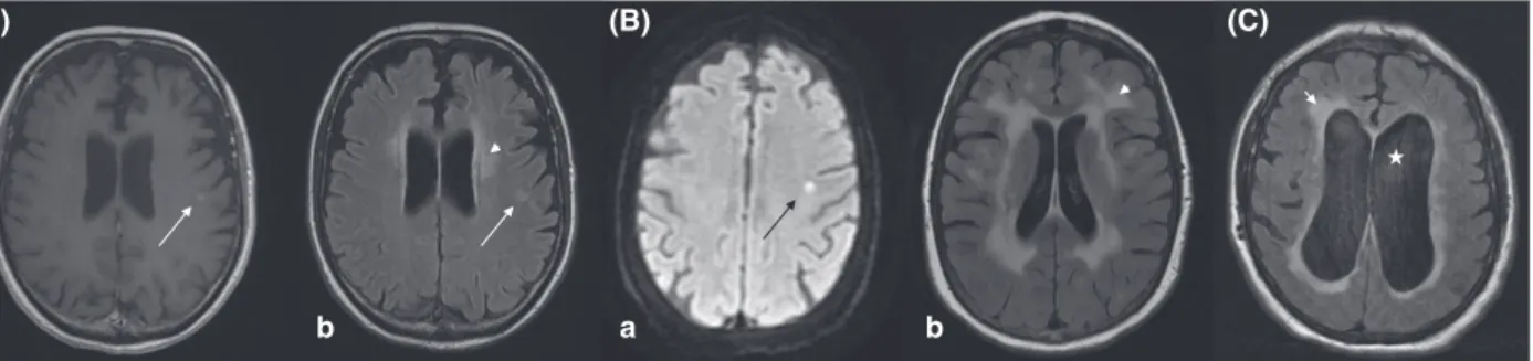 Fig 1. Examples of brain MRI images in 3 chronic lymphocytic leukaemia patients with central nervous sytem involvement
