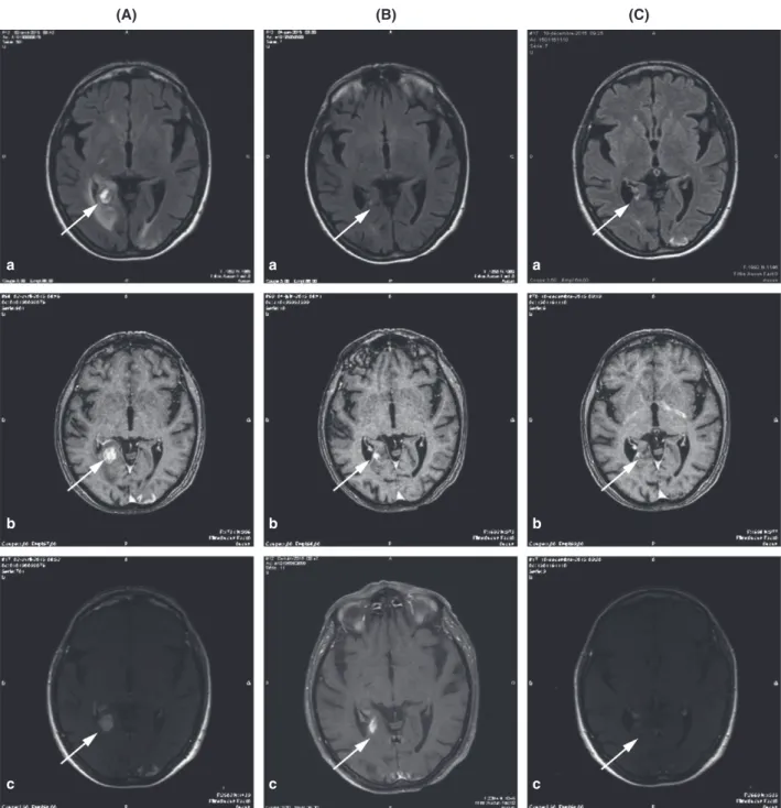 Fig 2. Brain magnetic resonance imaging (MRI) of a patient with central nervous system involvement (CNSi) who received ibrutinib
