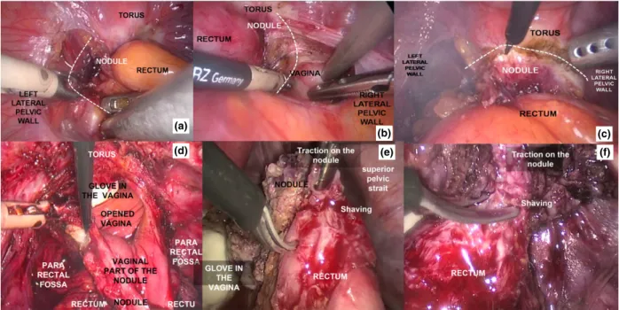 Figure 2. Principle of reverse technique: the objective is to free the nodule entirely before starting shaving on the rectum