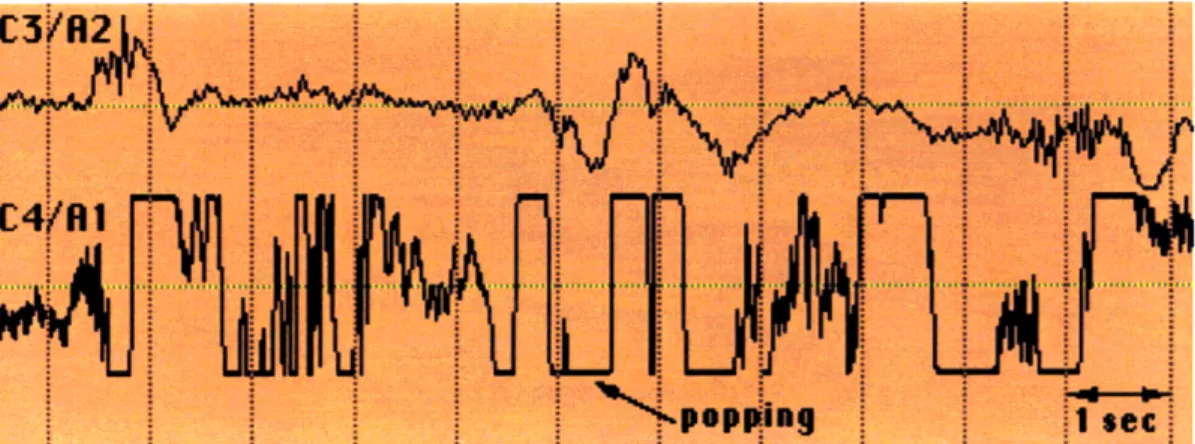 Figure  4.5:  Popping  Anomaly  on  an  EEG Signal