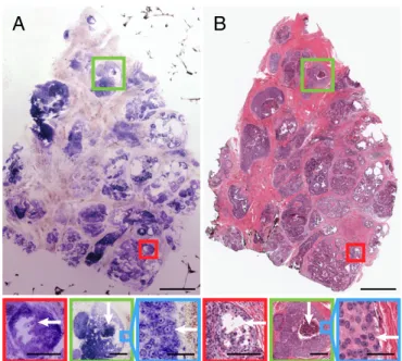 Fig. 3. Human breast specimen with DCIS in various histologic patterns. (A) NLM and (B) corresponding paraffin-embedded histology showing different DCIS subtypes