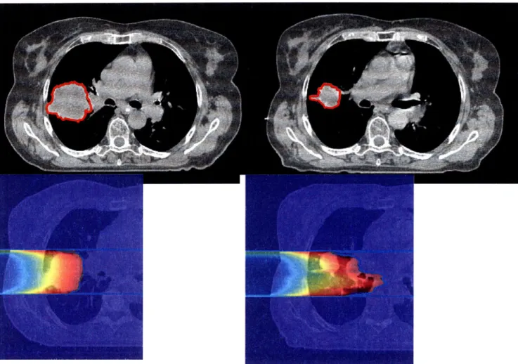 Figure  2-4:  Lung  tumor  CT  (top)  and  proton  treatment  plan  (bottom):  initial  scan,  gross  tumor volume (GTV)  115cc  (left),  5  weeks  into treatment,  GTV 39cc  (right)