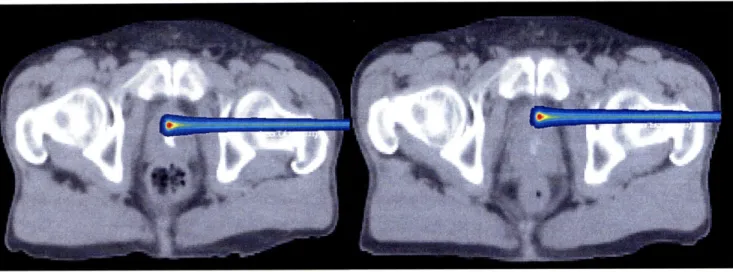 Figure  2-5:  Prostate  Treatment  CT  08  Jan  2000  (left)  and  11  Jan 2000  (right)
