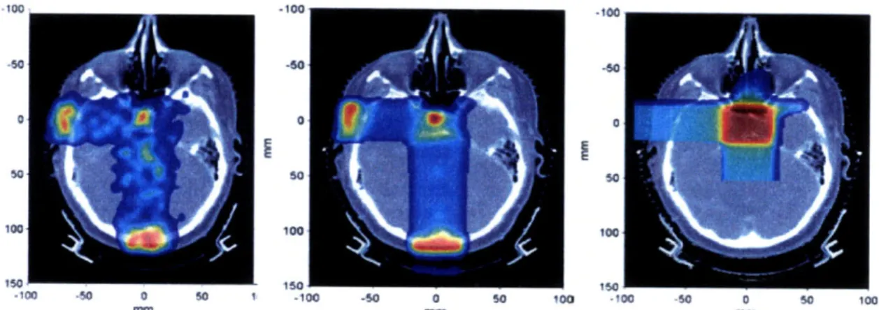 Figure  2-7:  Measured  PET (left)  Monte  Carlo PET  (middle)  and treatment plan dose  (right) for  a patient with pituitary adenoma receiving  two  orthogonal fields