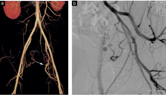 Figure 2 Contrast-enhanced computed tomography (a) and angiography (b) revealing a contrast-perfused sac originating from the ascending branch of the left uterine artery.
