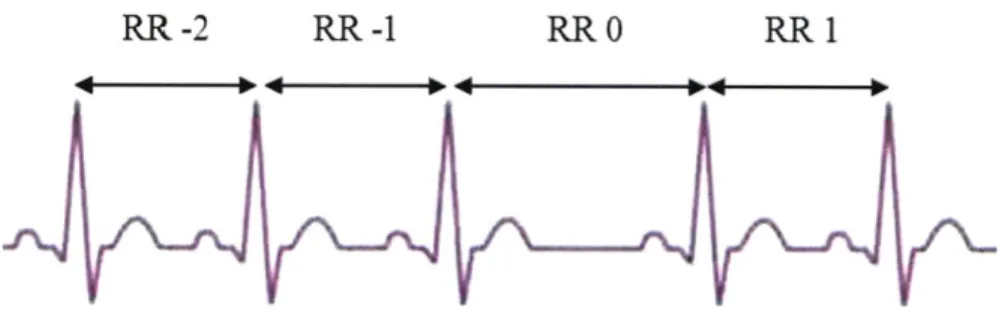 Figure 1-5.  RR  interval discretization for deceleration  capacity.  The  anchor is the identified  as the long RR  intervals where  one long  RR interval precedes  a shorter  one