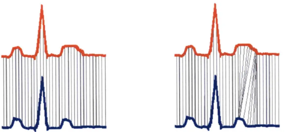 Figure 11-1.  Alignment of heart beats  using dynamic  time  warping. The two beats on the left depict  a comparison of the beats  using strictly the Euclidean distance