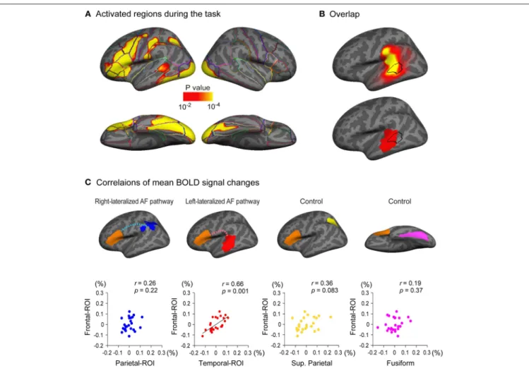 FIGURE 5 | Relationship between cortical response during a language task and the arcuate fasciculus (AF) projections