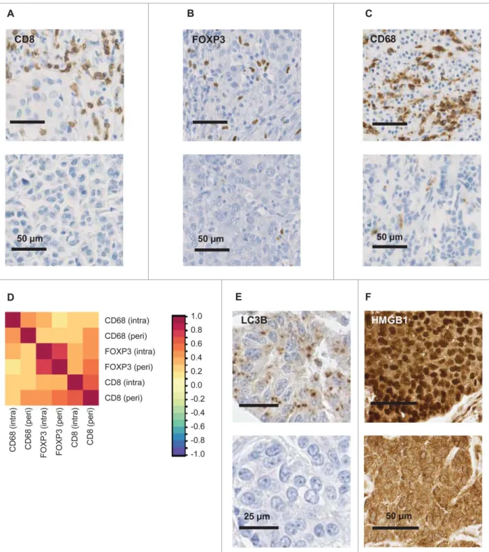 Figure 1. Representative immunohistochemical staining patterns. Breast cancer specimen were stained for the detection of CD8 C cytotoxic T lymphocytes (A), FOXP3 C regulatory T cells (B), CD68 C tumor-associated macrophages (C) and representative samples e