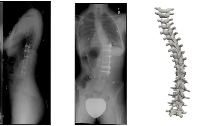 Fig. 1. Radiographs of a postoperative patient and the associated reconstruction. Left: