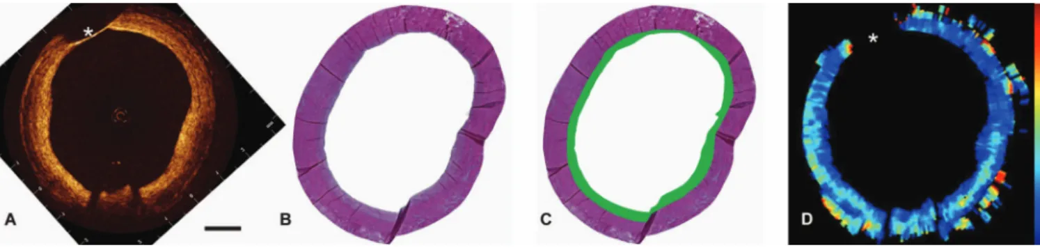 Fig. 3 共 A 兲 OCT image of a circumferential homogeneous intimal thickening case, length of the scale bar is 1 mm; 共 B 兲 corresponding histology, EvG stain; 共C兲 cartoon histology, highlighting a fibrous thickened intima; and 共D兲 the attenuation coefficient 