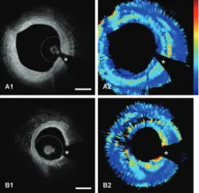Fig. 6 Optical attenuation imaging in vivo. Left column: OFDI im- im-ages; right column: optical attenuation; ⴱ marks the guidewire shadow