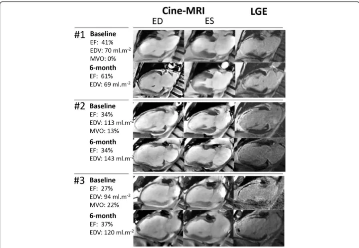 Fig. 2 Mid-ventricular vertical long-axis slices at baseline and at 6 months obtained from late gadolinium enhancement (LGE) images (right panel) and cine-MRI at end-diastole (ED, left panel) and end-systole (ES, middle panel), with LV parameters (EF for e