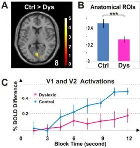Figure 2. Activations in sensory regions. ( A ) The brain images illustrate occipital activation for control and dyslexic groups