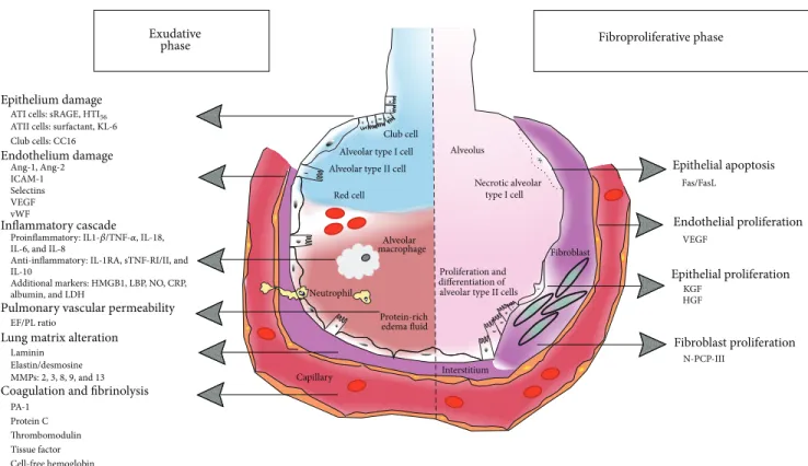 Figure 1: Biomarkers of acute respiratory distress syndrome organized by pathways and phases of lung injury (left: early exudative phase;