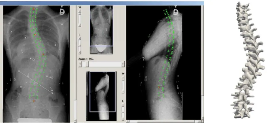 Fig. 1. Example of typical use of the proposed method. Left: User interface showing a posterior-anterior and a lateral radiograph, as well as landmarks identified by the user in red, and projections of anatomical landmarks from the reconstructed 3D model t