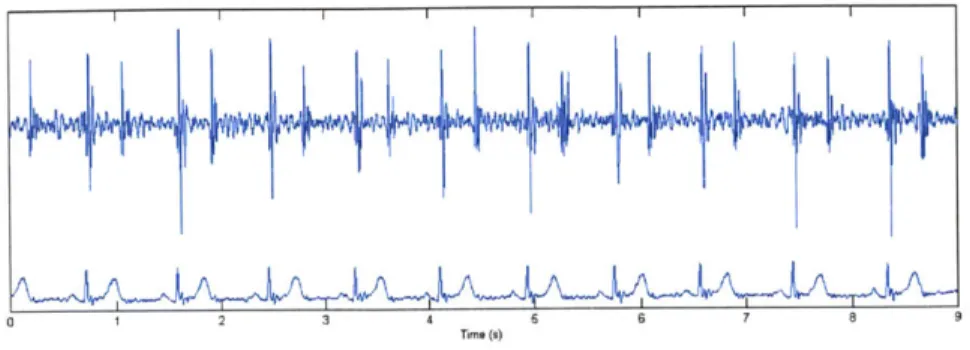 Figure  3-1:  Simultaneously  Recorded  Audio  and EKG  Signals.  Courtesy  of Z.  Syed.
