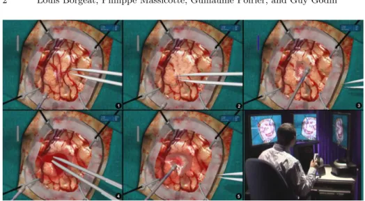 Fig. 1. Brain tumor resection with the Neurotouch simulator. 1. Initial brain surface.