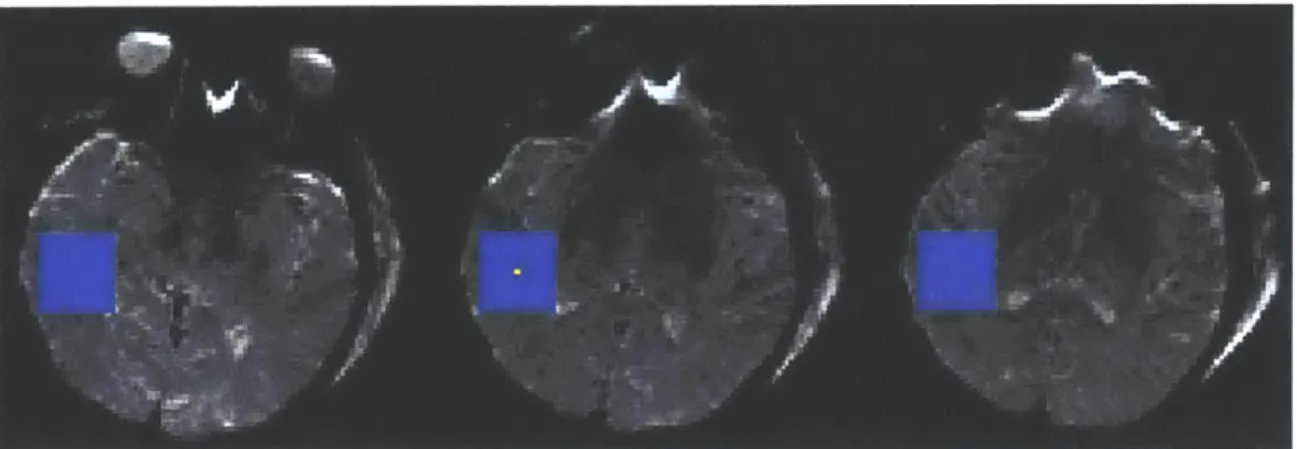 Figure  3.1.2  Example  of the relative  size  of the  (27mm) 3  search  cube  (blue)  for a  given voxel  (yellow)  in  the center  image