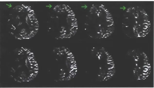 Figure  3.2.1  shows  four CBF  slices for a  single patient  that resulted from  using the local AIF  algorithm  (top row) as  well  as from using the standard  global  AIF  algorithm  (bottom row)