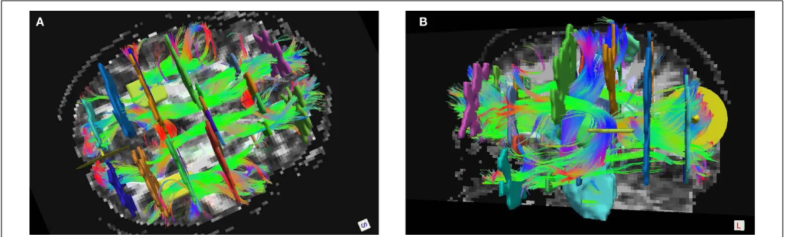 FIGURE 1 | Manual labeling of all 18 pathways in a single subject, shown in Trackvis with the disks and manually drawn ROIs that were used to define the pathways